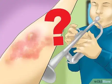Image titled Treat Vibration Induced Hives Step 7
