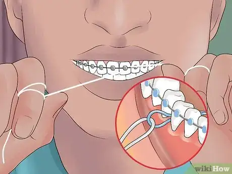 Image titled Be Happy with Braces Step 11
