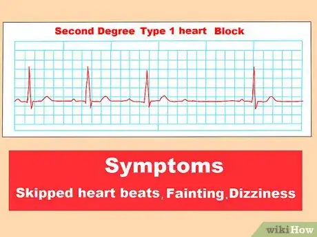 Image titled Identify Heart Blocks Step 10