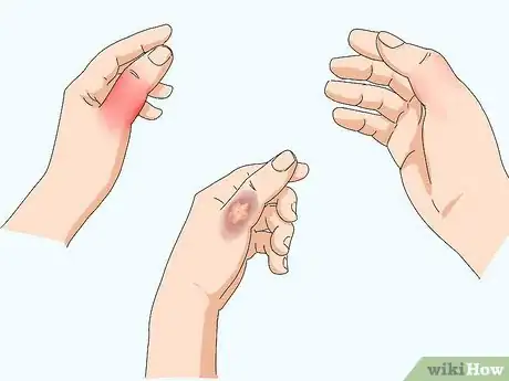 Image titled Wrap a Sprained Thumb Step 18