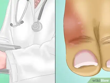 Image titled Relieve a Sore Damaged Toe Step 10