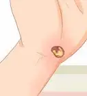Treat a Blood Blister