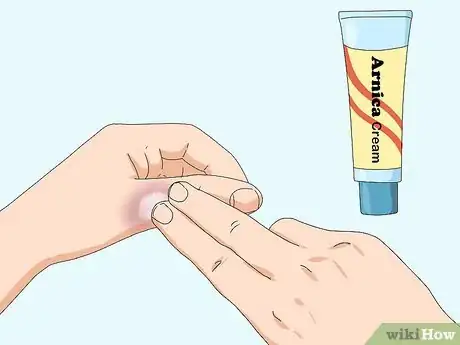 Image titled Wrap a Sprained Thumb Step 15