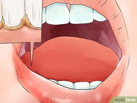 Image titled Identify if You Have Sensitive Teeth Step 6