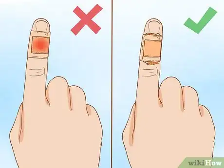 Image titled Apply Different Types of Bandages Step 12