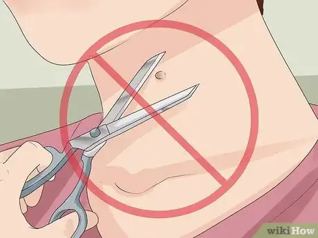 Image titled Get Rid of Skin Tags Step 21