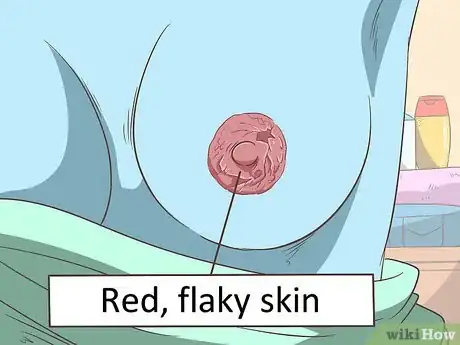 Image titled Treat Breast and Extramammary Paget's Disease Step 15