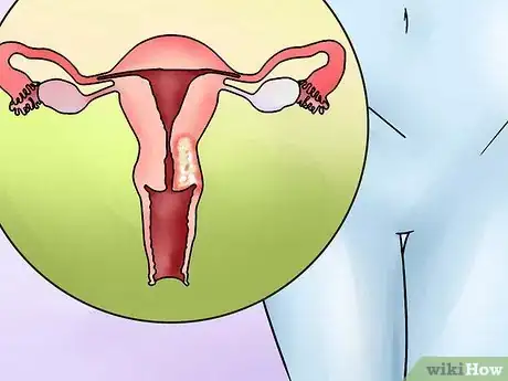 Image titled Identify Abnormal Vaginal Spotting Between Periods Step 15