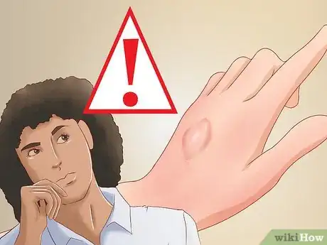 Image titled Recognize Frostbite Step 4