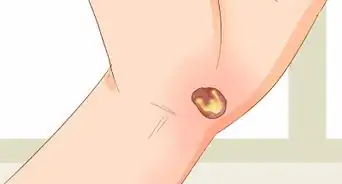 Treat a Blood Blister