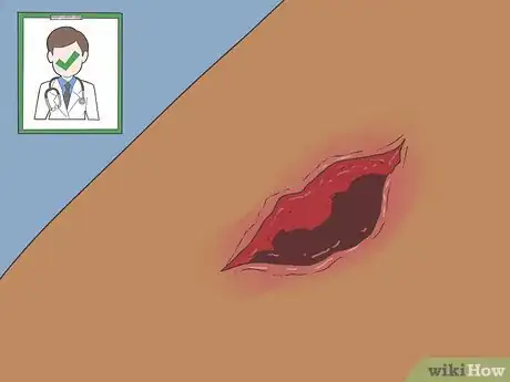 Image titled Know if a Wound Is Healing Step 14