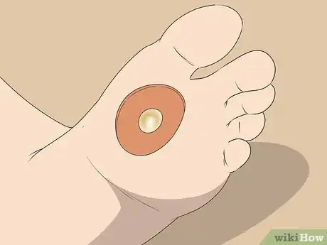 Image titled Freeze Plantar Warts Step 7