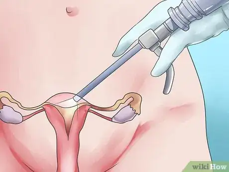 Image titled Eliminate Postpartum Hemorrhage Step 5