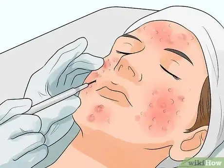Image titled Clear up Acne With Hydrogen Peroxide Step 13