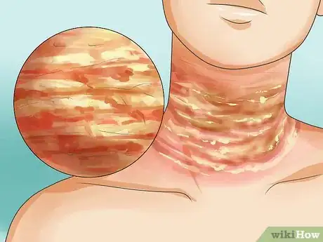 Image titled Recognize Scabies Rash Step 5