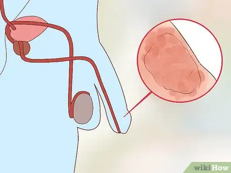 Image titled Reduce the Risk of Hospital Spread Infections Step 11