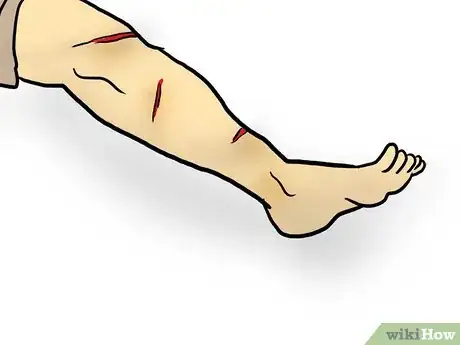 Image titled Complete a Top to Toe Assessment of an Injury Step 13