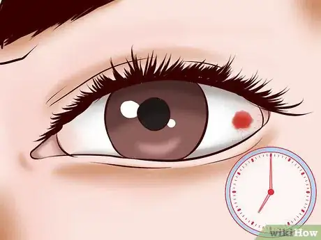 Image titled Get Rid of a Red Eye Step 5