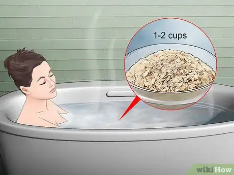 Image titled Treat Sand Flea Bites Step 5