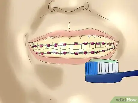 Image titled Make Out With Braces Step 12