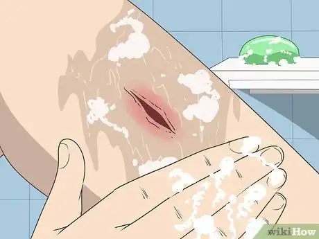 Image titled Know if a Wound Is Healing Step 10