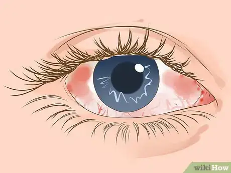 Image titled Recognize the Signs of Pain Killer Addiction Step 6