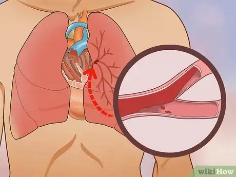 Image titled Treat Obstructive Shock Step 1