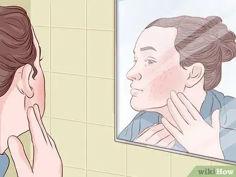 Image titled Treat Sunburn with Natural Remedies Step 11