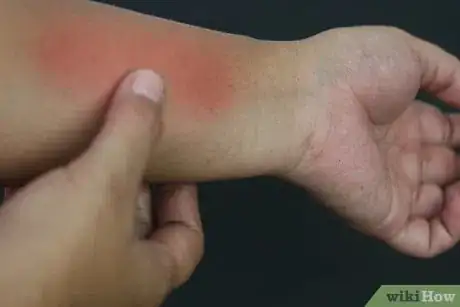 Image titled Soothe Bites and Stings with Vodka Step 8