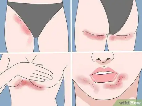 Image titled Diagnose a Yeast Infection at Home Step 1