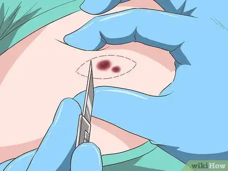 Image titled Diagnose Sarcoma Step 13
