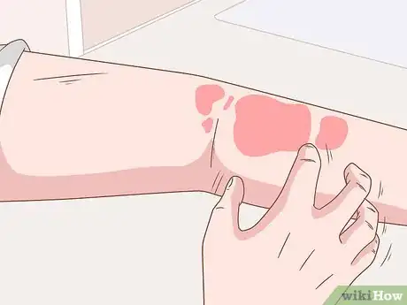 Image titled Live With an Allergy to Sulfites Step 6