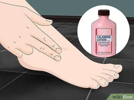 Image titled Treat Sand Flea Bites Step 2