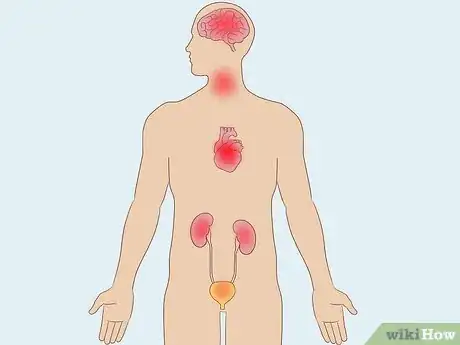 Image titled Treat Hypersomnia Step 4