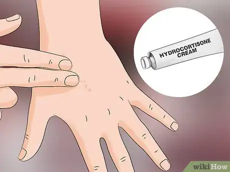 Image titled Treat Sand Flea Bites Step 3