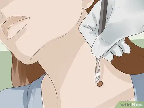 Image titled Get Rid of Skin Tags Step 2