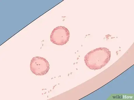 Image titled Diagnose a Yeast Infection at Home Step 5