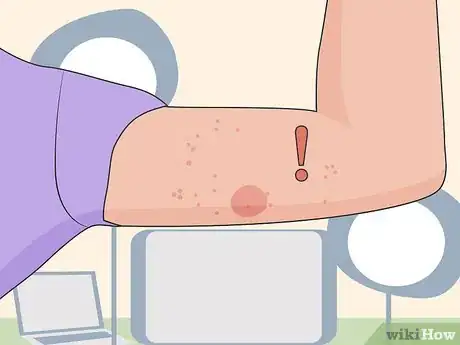 Image titled Remove Nexplanon Step 13
