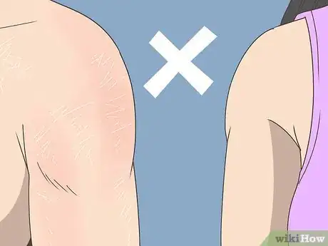 Image titled Treat Ichthyosis Step 21