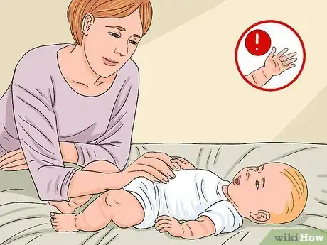 Image titled Deal with Amniotic Band Syndrome Step 6