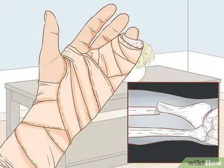 Image titled Apply Different Types of Bandages Step 14