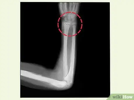 Image titled Treat a Growth Plate Fracture Step 4