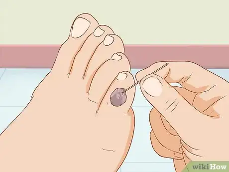 Image titled Treat a Blood Blister Step 10