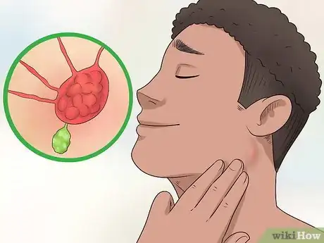 Image titled Check Lymph Nodes Step 6