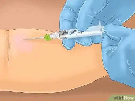 Image titled Diagnose Hereditary Angiodema Step 3