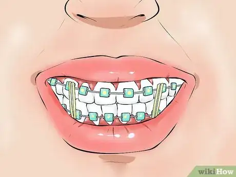 Image titled Deal With Dental Devices Step 4