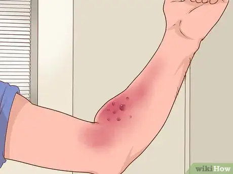 Image titled Dry Up Poison Ivy Rash Step 12