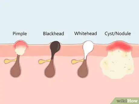 Image titled Treat Adult Acne Step 11