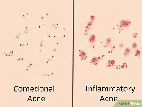 Image titled Get Rid of Acne if You Have Fair Skin Step 1