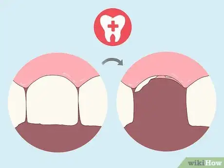 Image titled Pull a Loose Tooth at Home Step 14